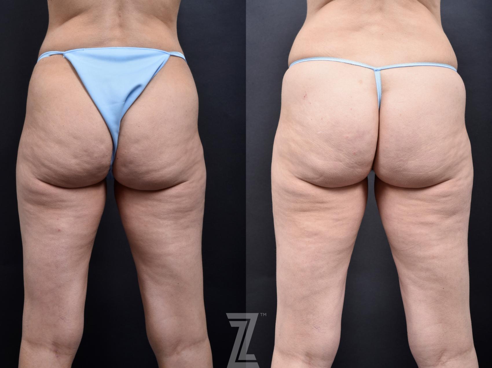 Avéli Before & After Photo | Austin, TX | The Piazza Center for Plastic Surgery & Advanced Skin Care