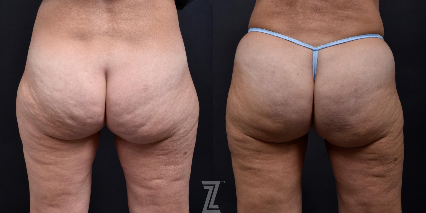 Avéli Before & After Photo | Austin, TX | The Piazza Center for Plastic Surgery & Advanced Skin Care
