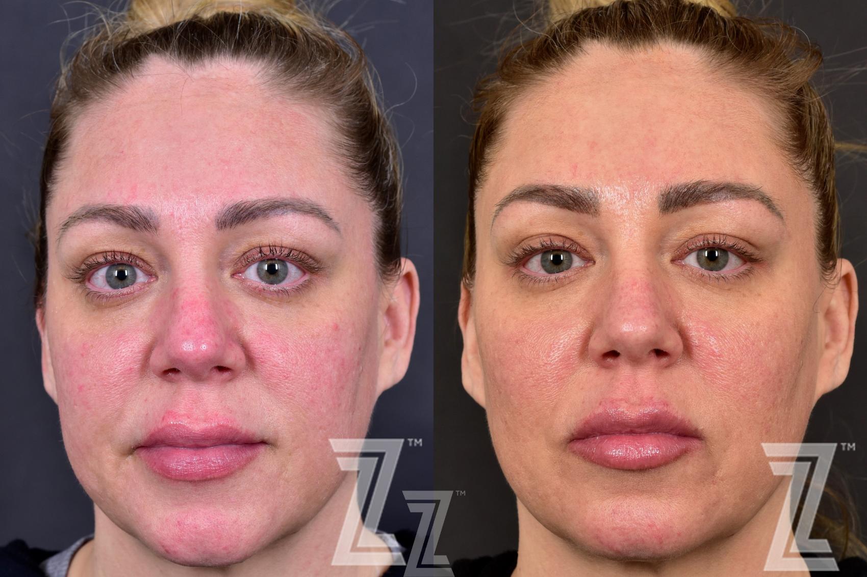 BBL Before & After Photo | Austin, TX | The Piazza Center for Plastic Surgery & Advanced Skin Care