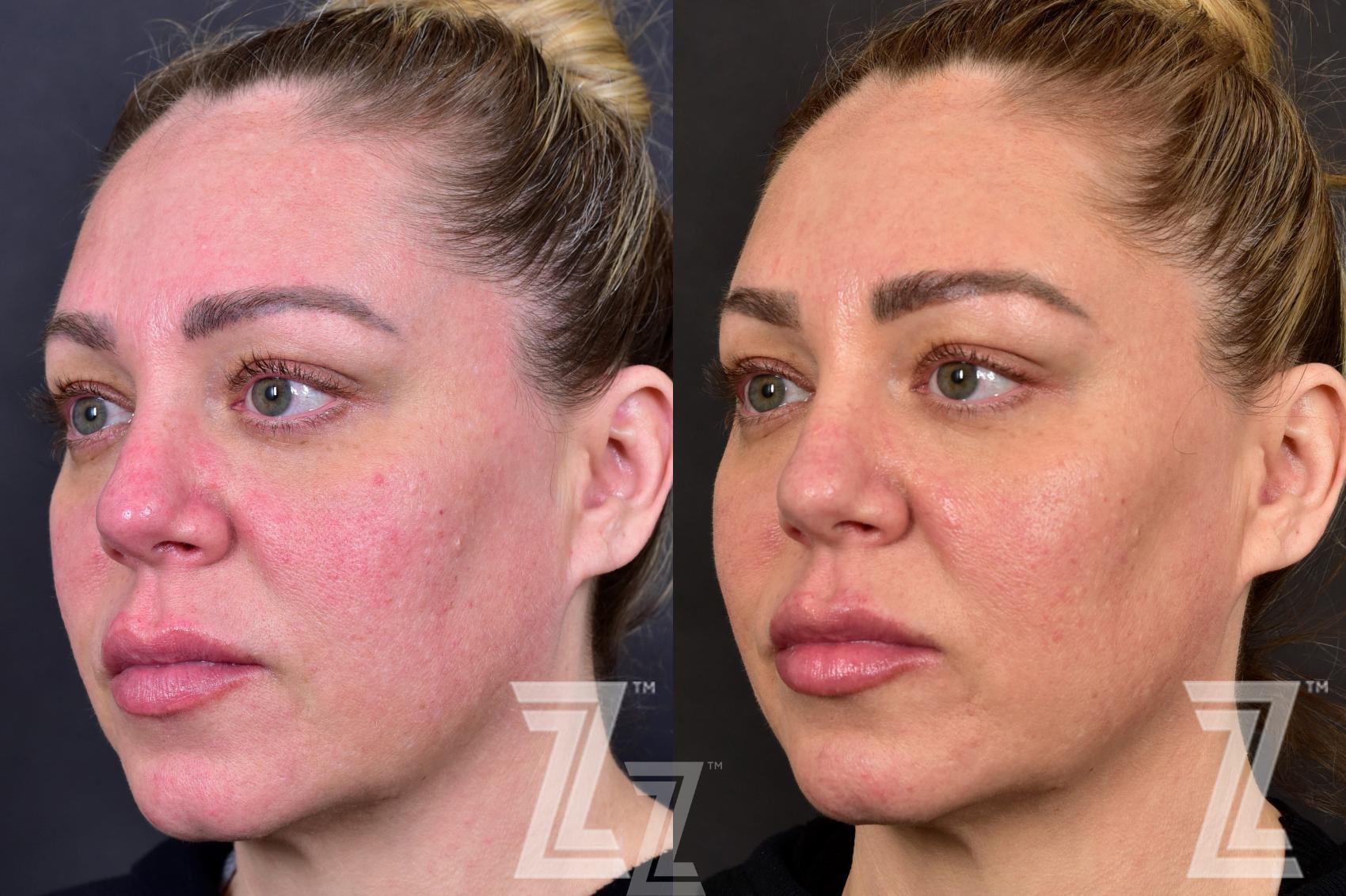 Before And After Photos Bbl Laser Therapy Laser Medical Aesthetician