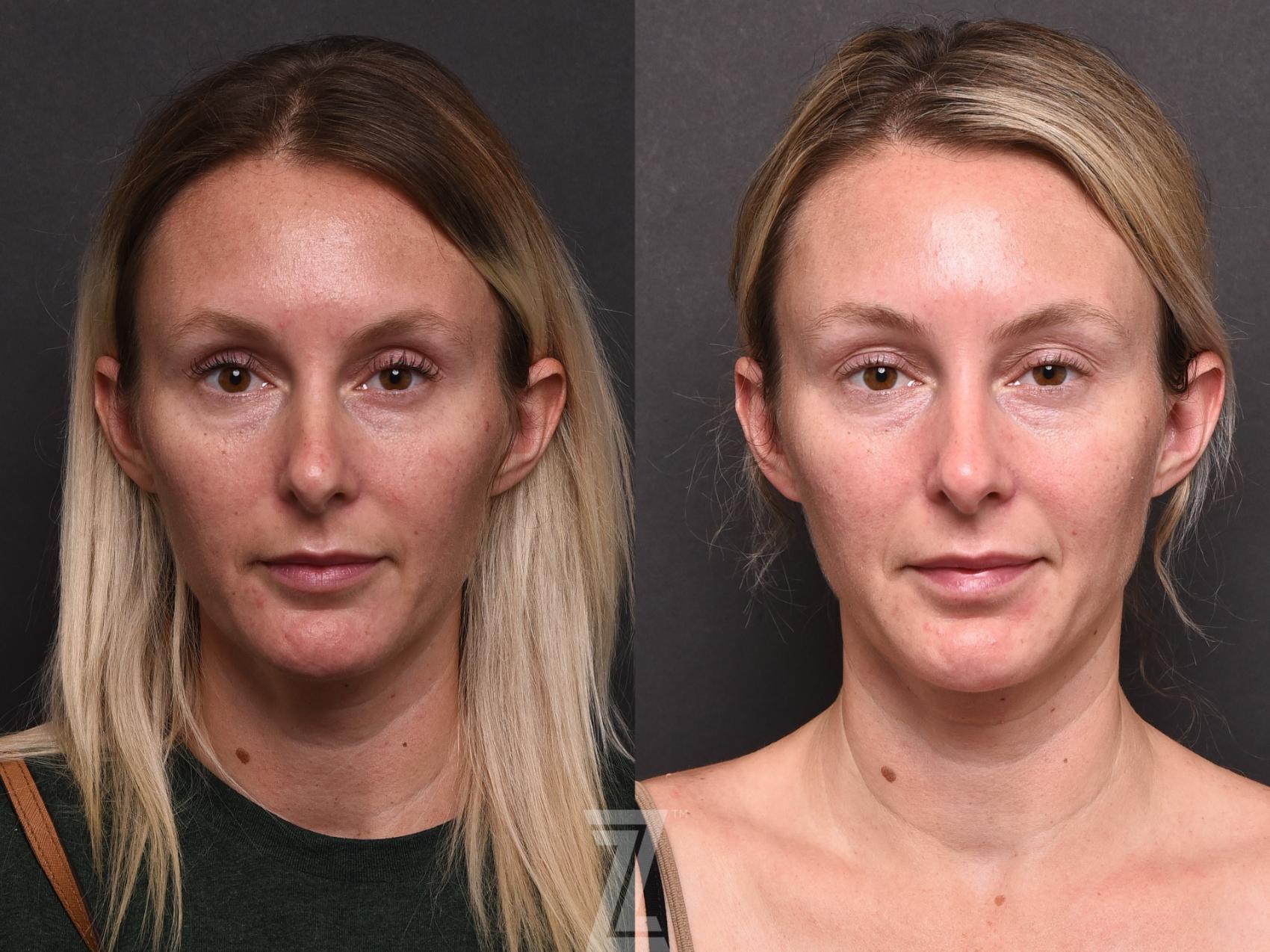 Botox, Neurotoxin, Dysport, Before and After, B&A, Tummy Tuck, Breast Aug, Breast Lift, Mastopexy, MMO, Mommy Makeover, Dr. Rocco Piazza, The Piazza Center, Austin, Tx, Halo, BBLlaser