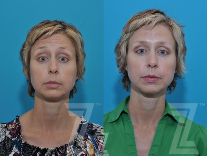 BOTOX® Cosmetic Before & After Photos Patient 100 | Austin, TX | The