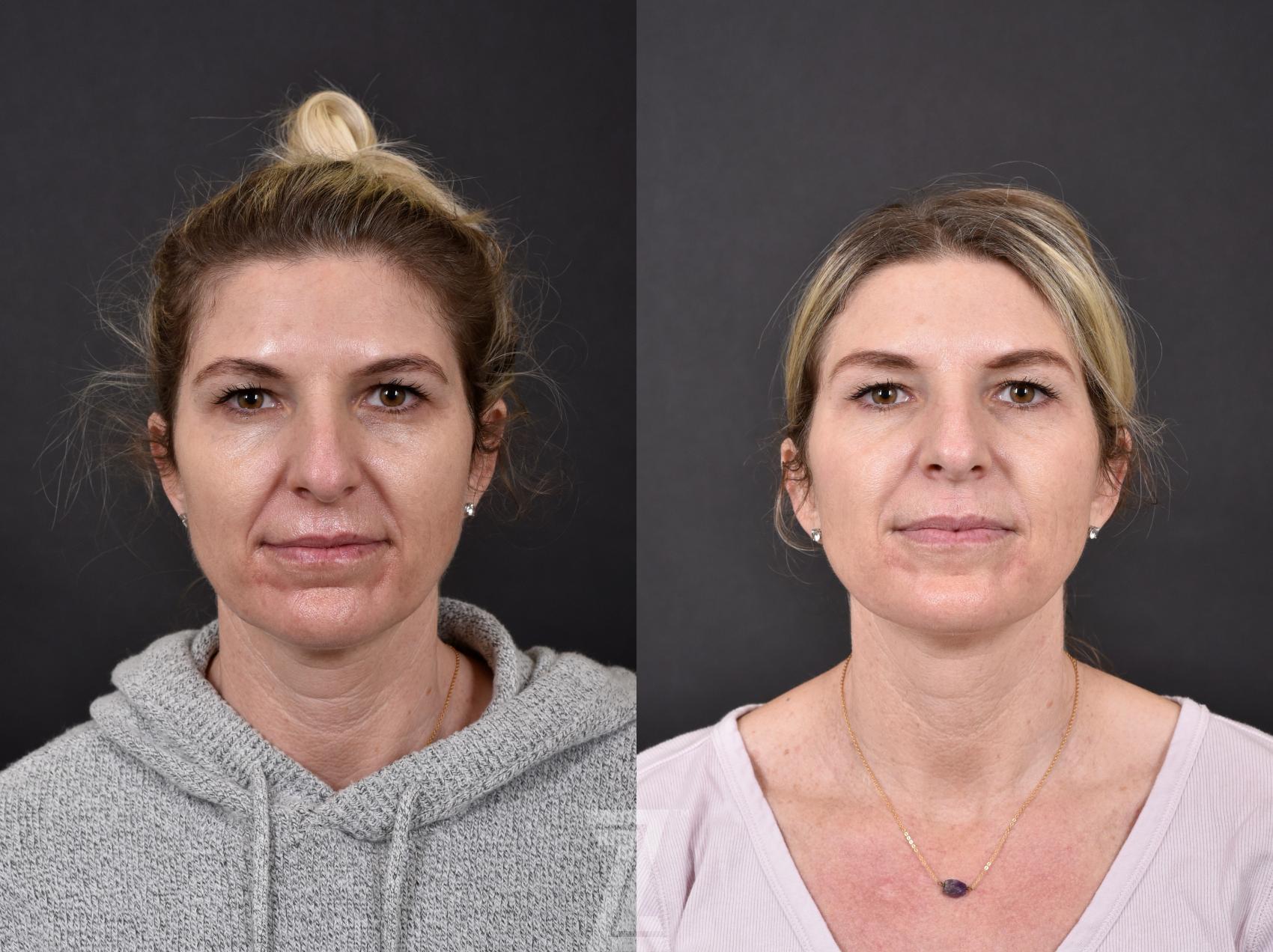 BOTOX® Cosmetic Before & After Photo | Austin, TX | The Piazza Center for Plastic Surgery & Advanced Skin Care