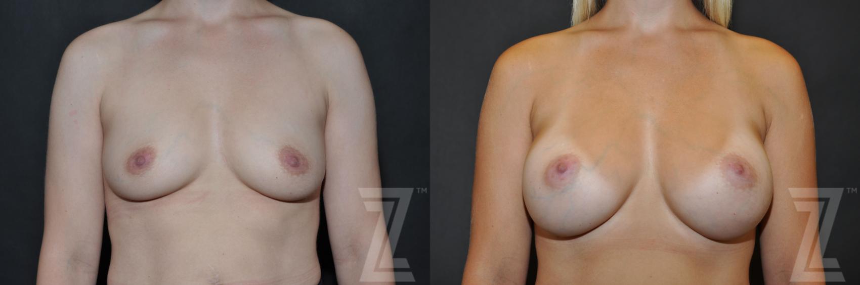 Breast Augmentation Before & After Photo | Austin, TX | The Piazza Center for Plastic Surgery & Advanced Skin Care