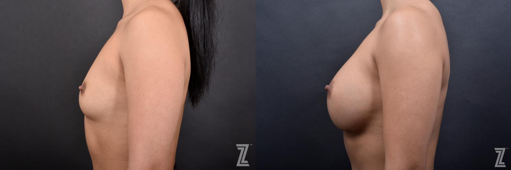 Breast Augmentation Before & After Photo | Austin, TX | The Piazza Center for Plastic Surgery & Advanced Skin Care