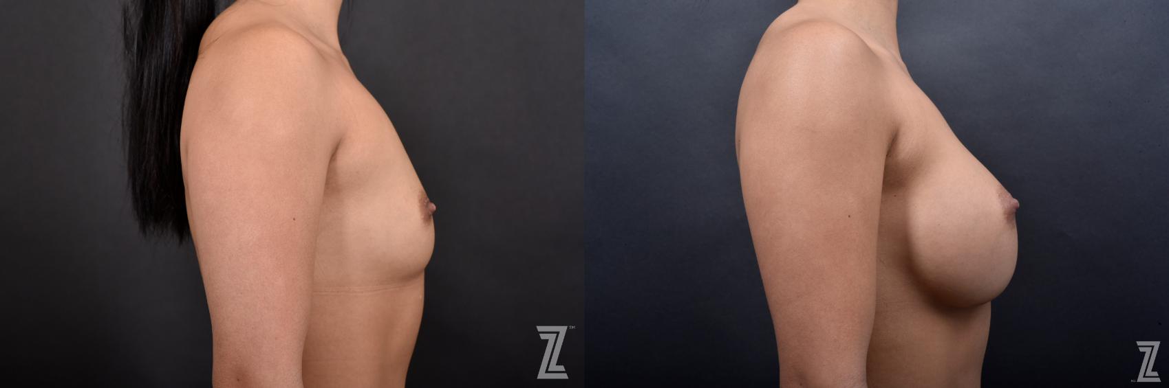 Breast Augmentation Before & After Photo | Austin, TX | The Piazza Center for Plastic Surgery & Advanced Skin Care