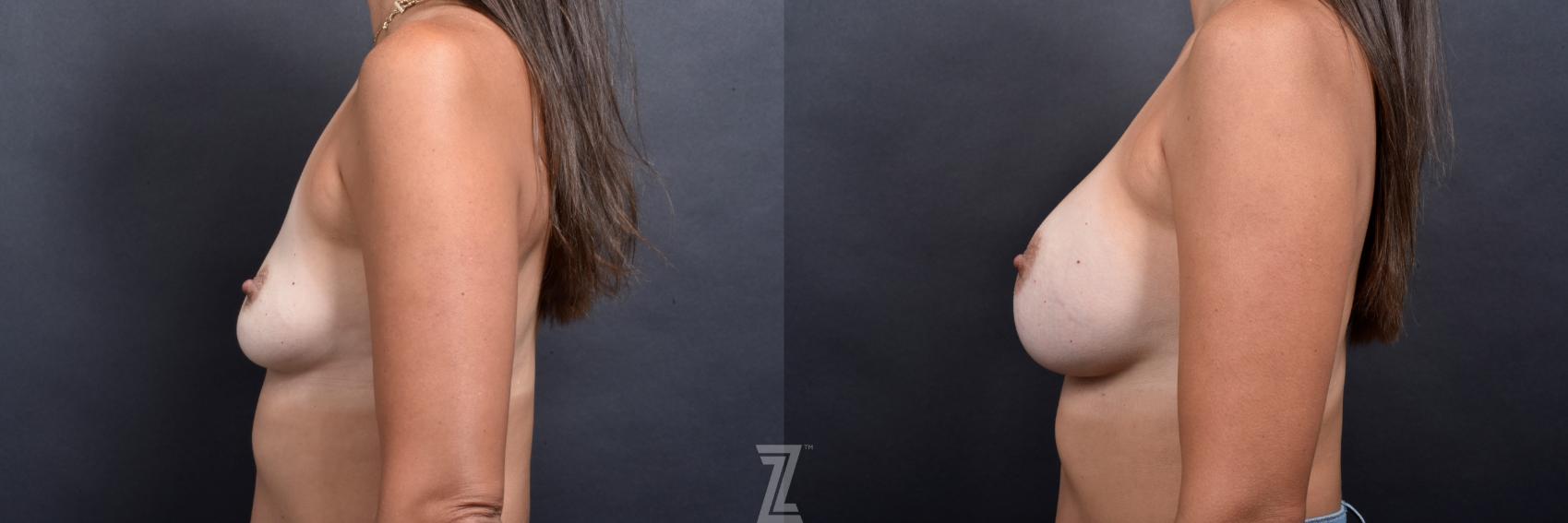 Breast Augmentation Before & After Photo | Austin, TX | The Piazza Center for Plastic Surgery & Advanced Skin Care