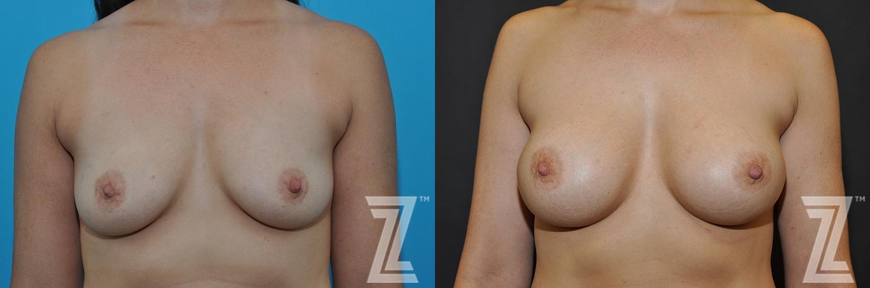 Breast Augmentation Before & After Photo | Austin, TX | The Piazza Center for Plastic Surgery & Advanced Skin Care