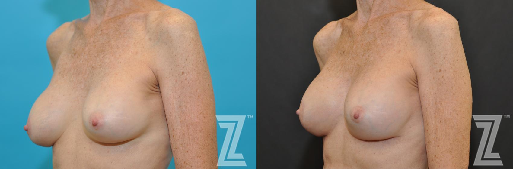 Breast Augmentation Revision Before & After Photo | Austin, TX | The Piazza Center for Plastic Surgery & Advanced Skin Care