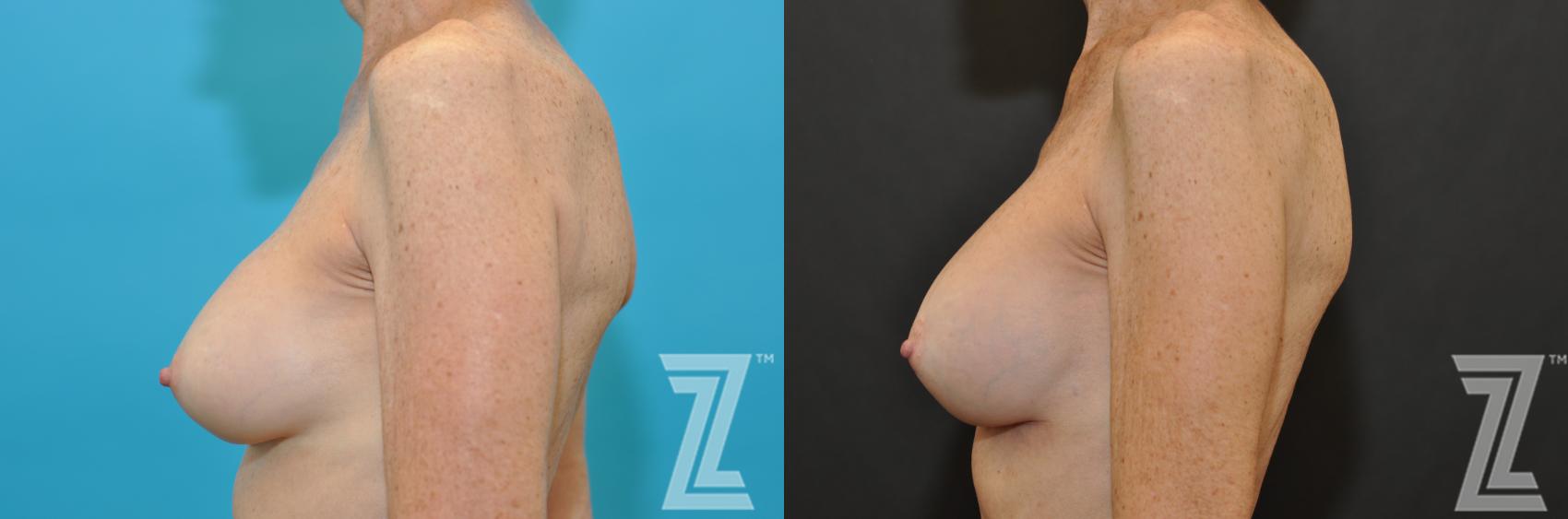 Breast Augmentation Revision Before & After Photo | Austin, TX | The Piazza Center for Plastic Surgery & Advanced Skin Care