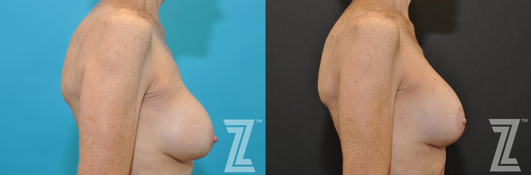 Breast Augmentation Revision Before & After Photo | Austin, TX | The Piazza Center for Plastic Surgery & Advanced Skin Care