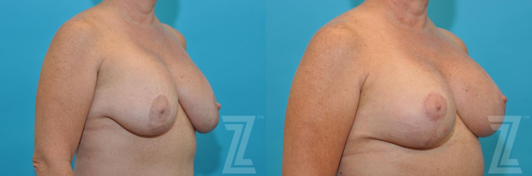 Breast Augmentation Revision Before & After Photo | Austin, TX | The Piazza Center for Plastic Surgery & Advanced Skin Care