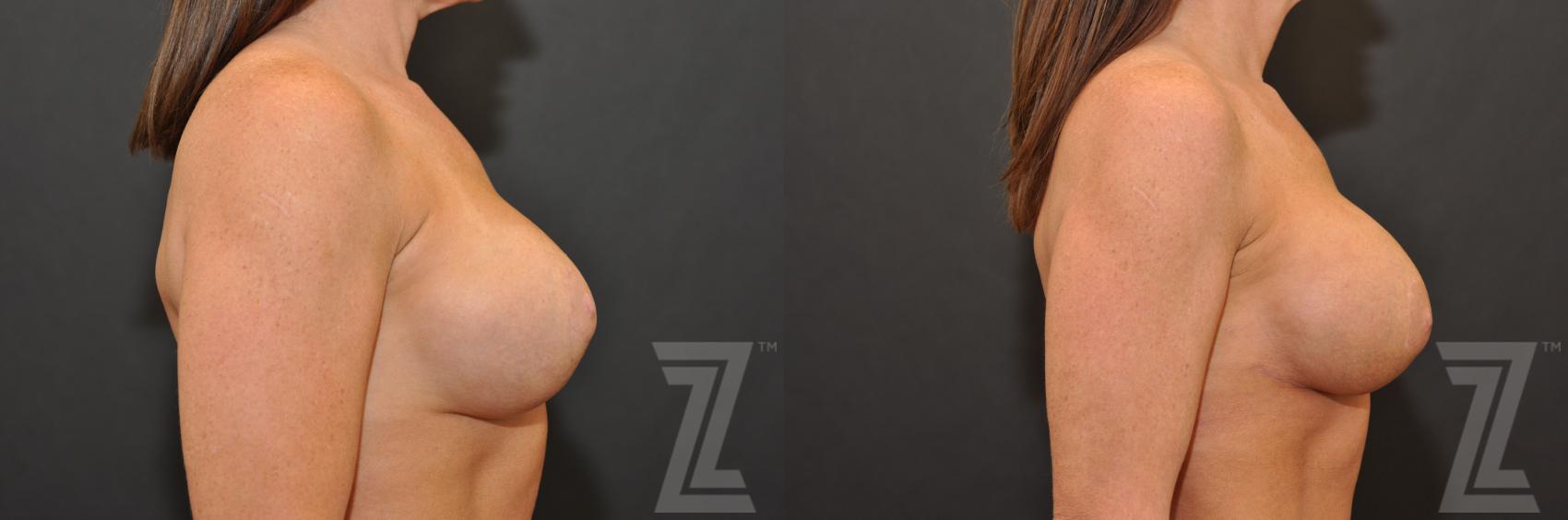 Breast Augmentation Revision Before & After Photo | Austin, TX | The Piazza Center for Plastic Surgery & Advanced Skin Care