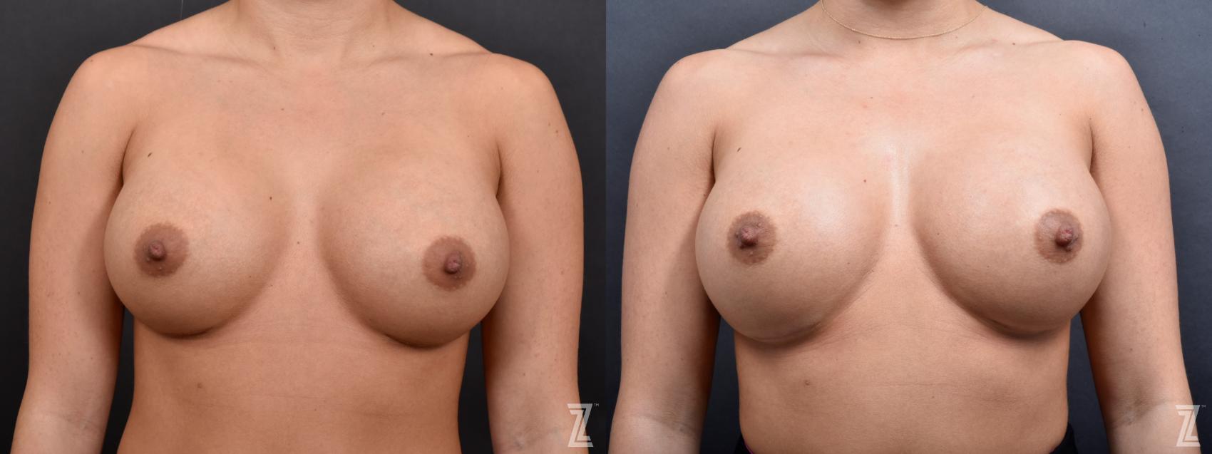 Breast Augmentation Revision Before & After Photo | Austin, TX | The Piazza Center for Plastic Surgery & Advanced Skin Care