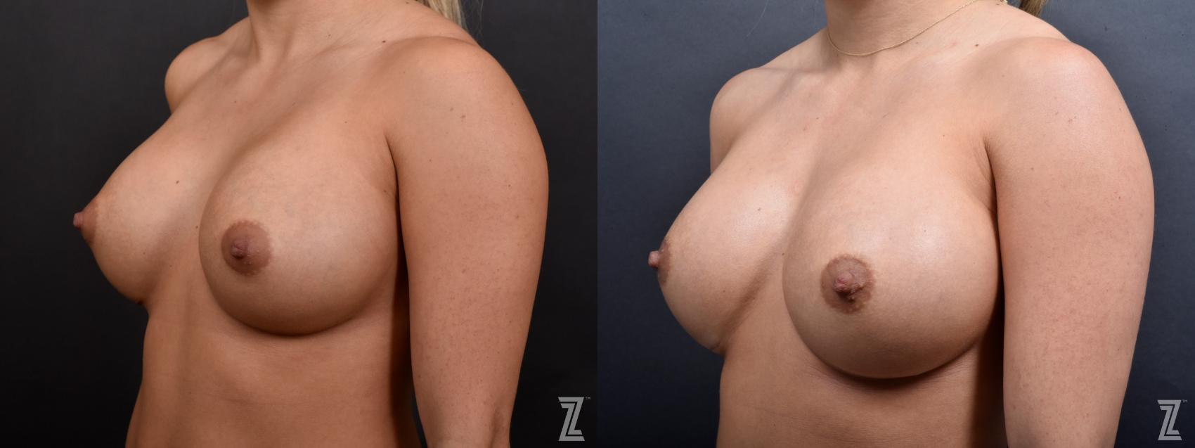 Breast Augmentation Revision Before & After Photo | Austin, TX | The Piazza Center for Plastic Surgery & Advanced Skin Care
