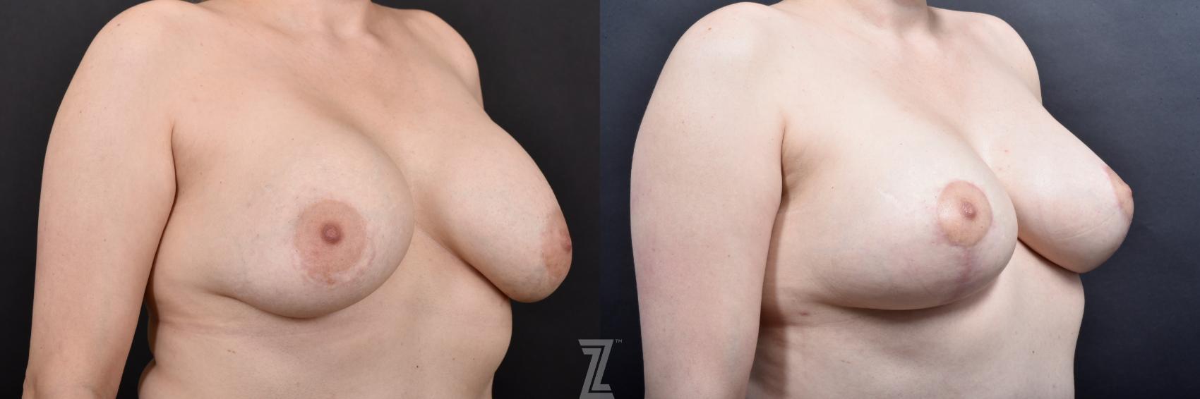 Breast Augmentation Revision Before & After Photo | Austin, TX | The Piazza Center for Plastic Surgery & Advanced Skin Care