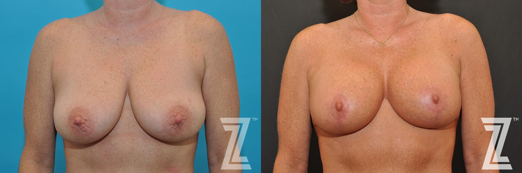 Breast Augmentation with a Breast Lift Before & After Photo | Austin, TX | The Piazza Center for Plastic Surgery & Advanced Skin Care