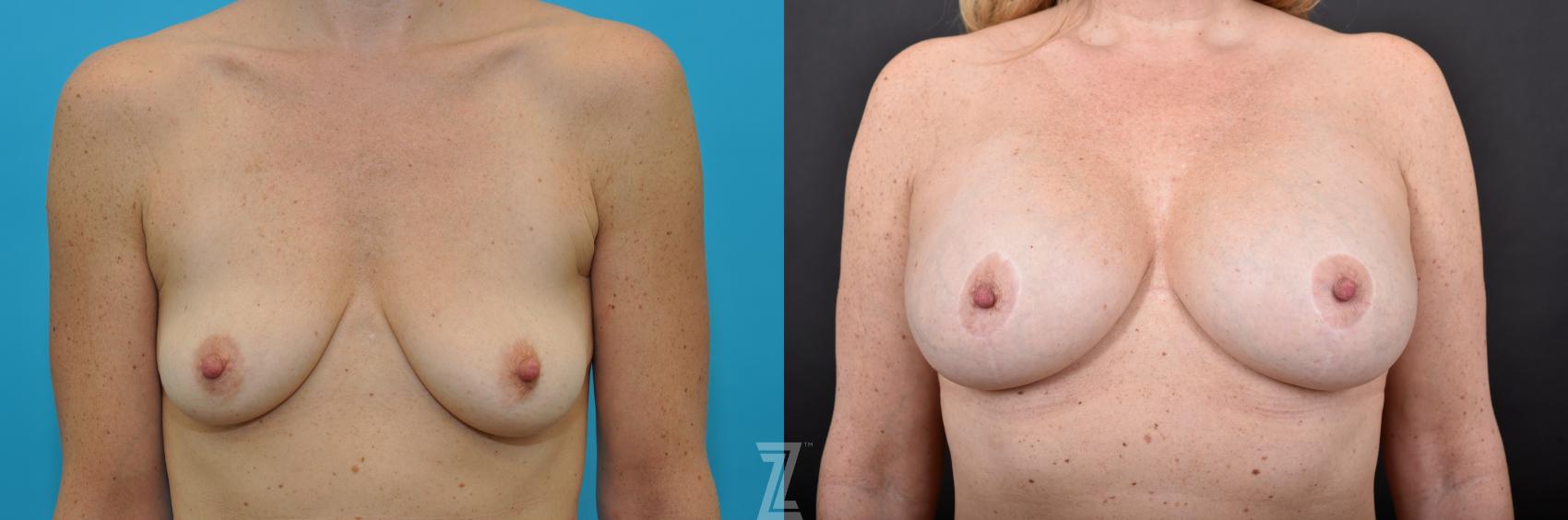 Breast Augmentation with a Breast Lift Before & After Photo | Austin, TX | The Piazza Center for Plastic Surgery & Advanced Skin Care