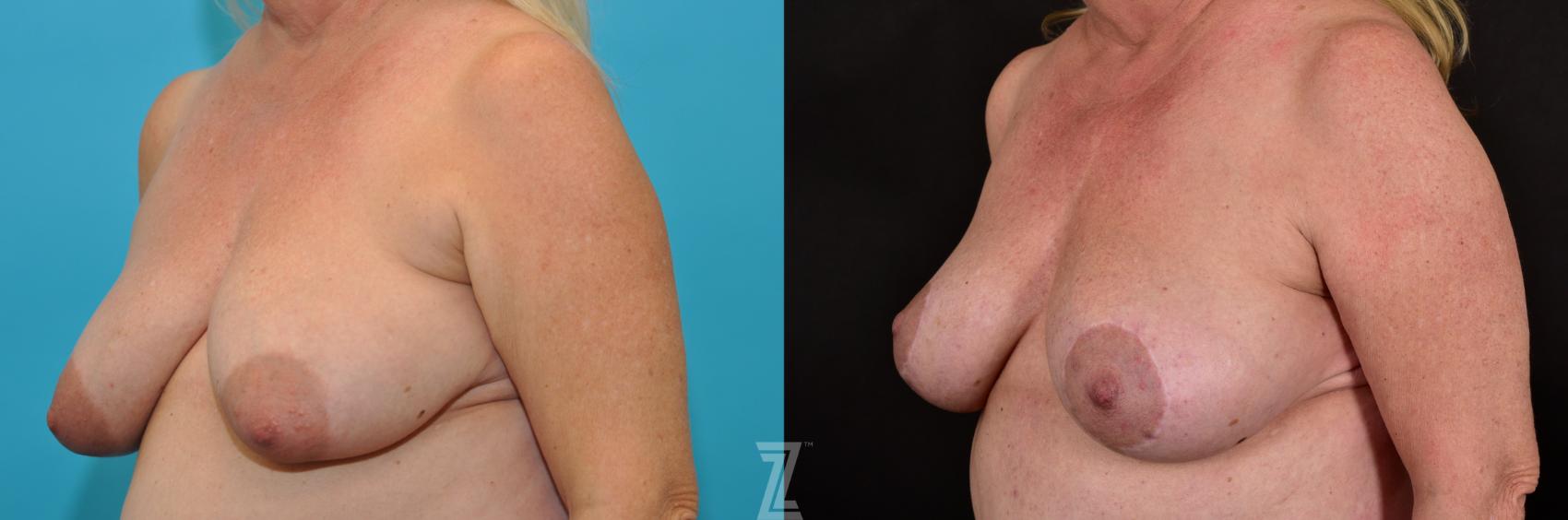 Breast Lift Before & After Photo | Austin, TX | The Piazza Center for Plastic Surgery & Advanced Skin Care