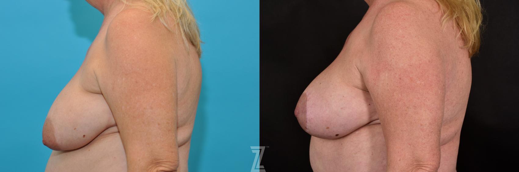 Breast Lift Before & After Photo | Austin, TX | The Piazza Center for Plastic Surgery & Advanced Skin Care