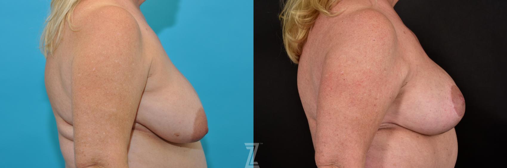 Breast Lift Before & After Photo | Austin, TX | The Piazza Center for Plastic Surgery & Advanced Skin Care