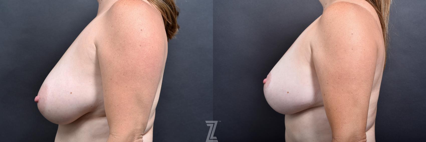 Breast Lift Before & After Photo | Austin, TX | The Piazza Center for Plastic Surgery & Advanced Skin Care