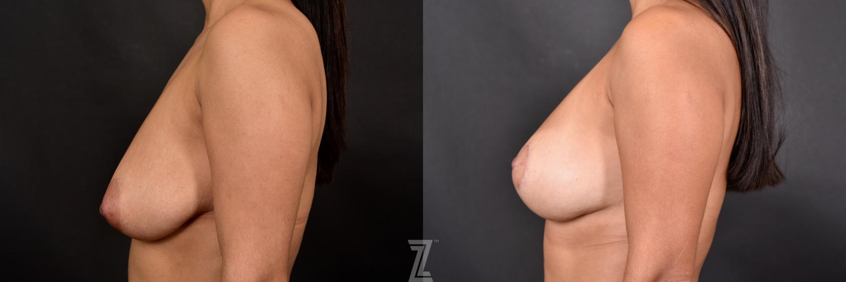Breast Lift Before & After Photo | Austin, TX | The Piazza Center for Plastic Surgery & Advanced Skin Care
