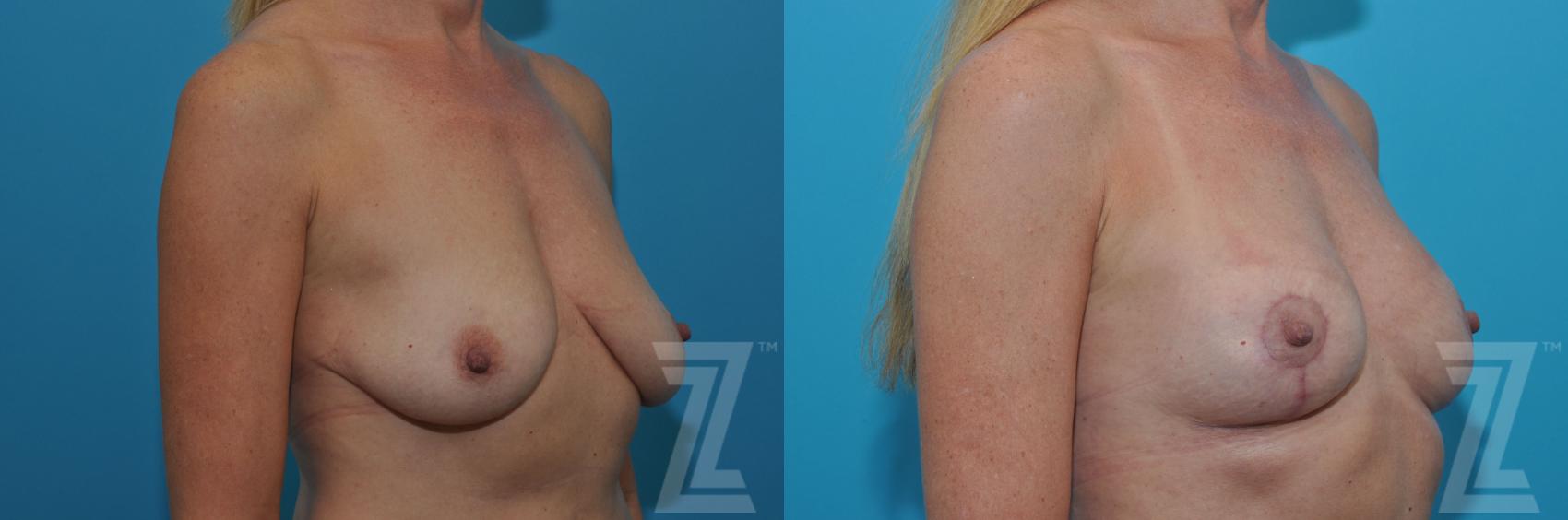 Breast Lift Before & After Photo | Austin, TX | The Piazza Center for Plastic Surgery & Advanced Skin Care