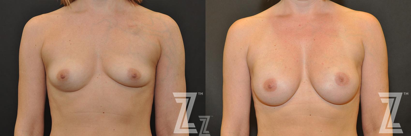 Breast Reconstruction Before & After Photo | Austin, TX | The Piazza Center for Plastic Surgery & Advanced Skin Care