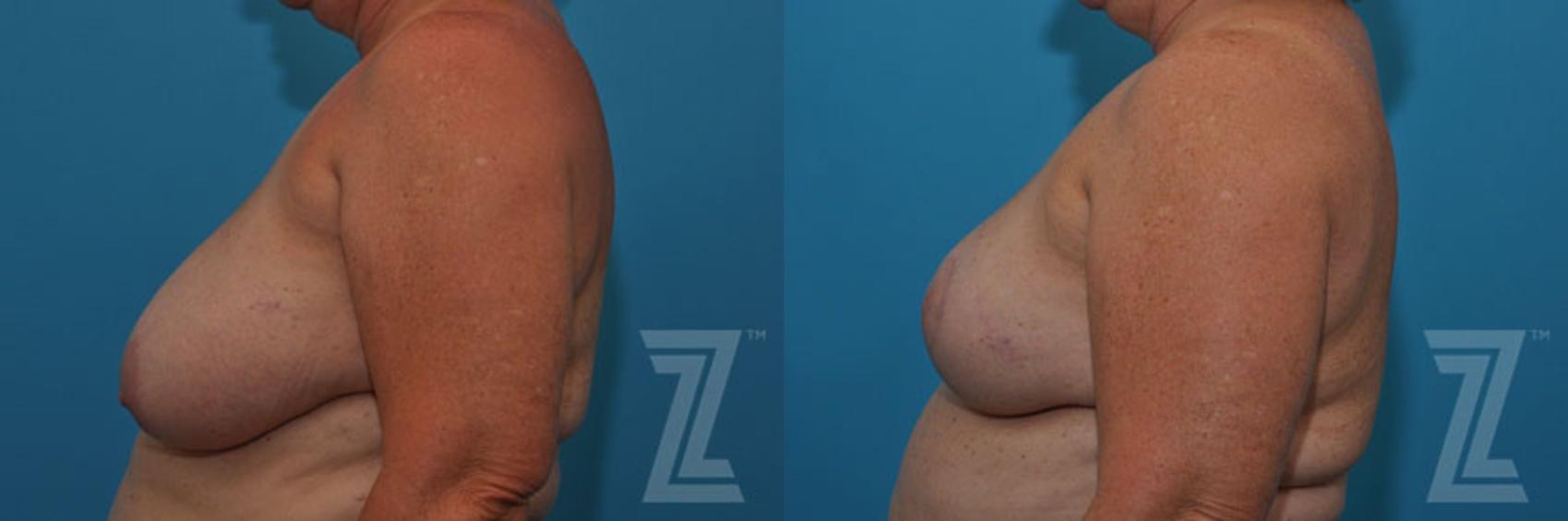 Breast Reduction Before & After Photo | Austin, TX | The Piazza Center for Plastic Surgery & Advanced Skin Care
