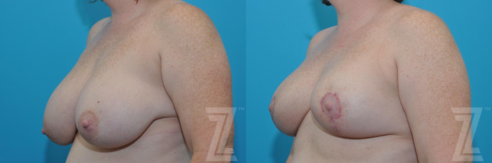 Breast Reduction Before & After Photo | Austin, TX | The Piazza Center for Plastic Surgery & Advanced Skin Care