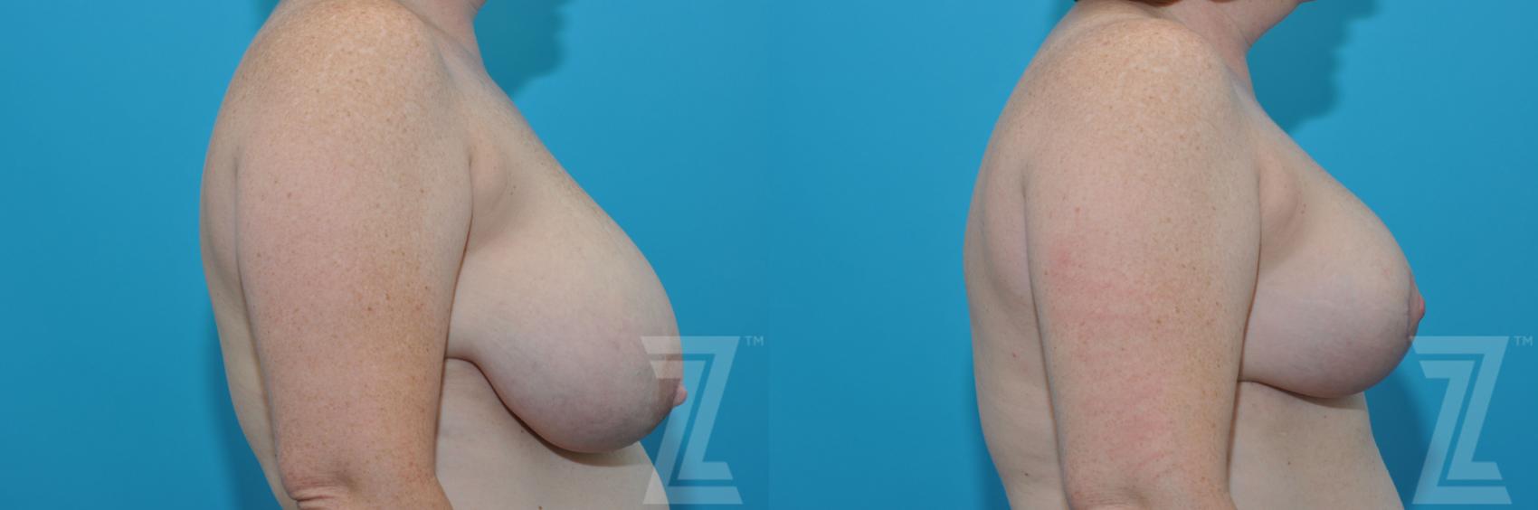 Breast Reduction Before & After Photo | Austin, TX | The Piazza Center for Plastic Surgery & Advanced Skin Care