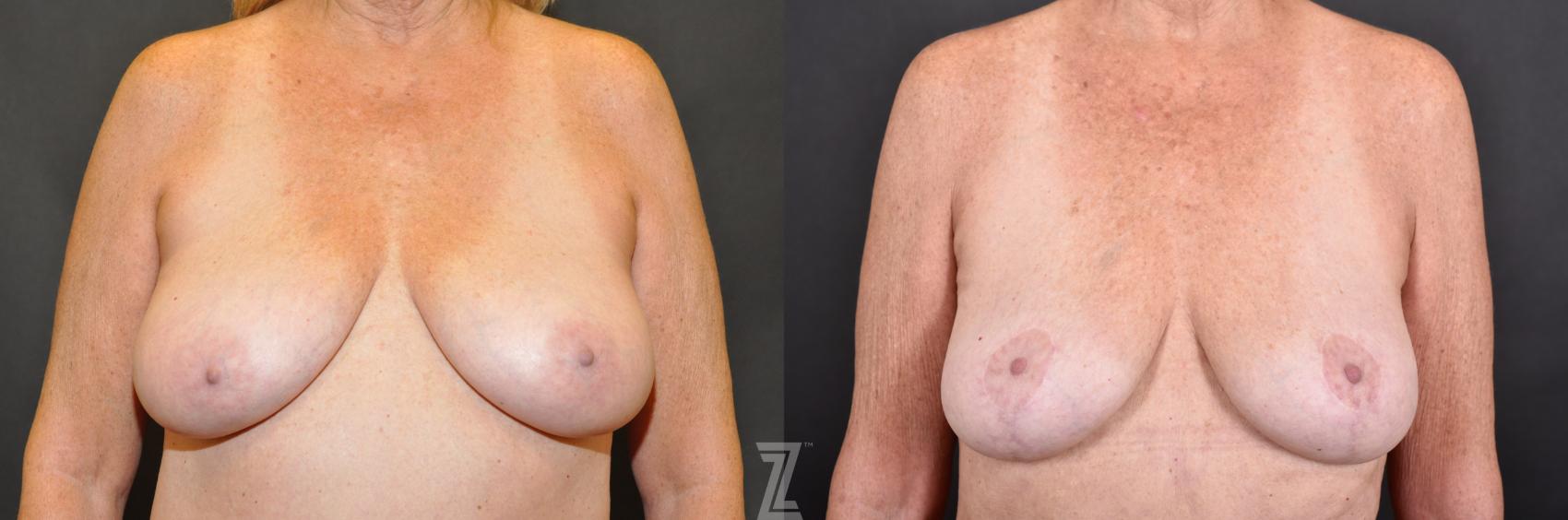 Breast Reduction Before & After Photo | Austin, TX | The Piazza Center for Plastic Surgery & Advanced Skin Care