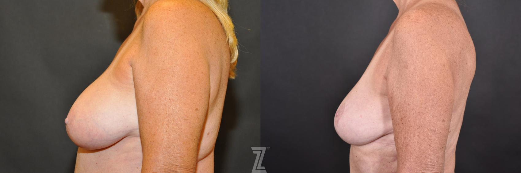 Breast Reduction Before & After Photo | Austin, TX | The Piazza Center for Plastic Surgery & Advanced Skin Care