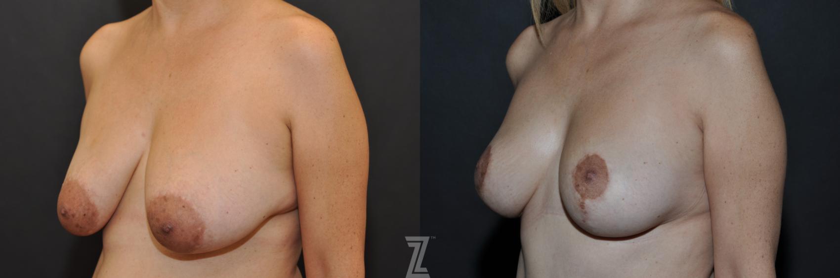 Breast Reduction Before & After Photo | Austin, TX | The Piazza Center for Plastic Surgery & Advanced Skin Care