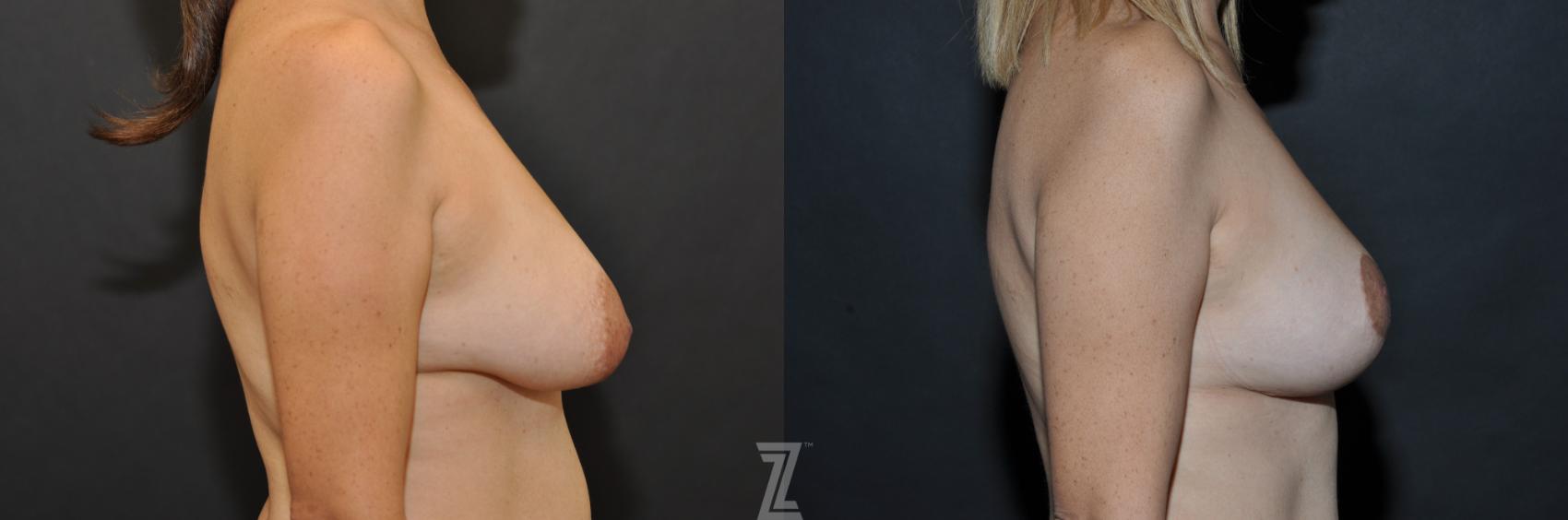 Breast Reduction Before & After Photo | Austin, TX | The Piazza Center for Plastic Surgery & Advanced Skin Care