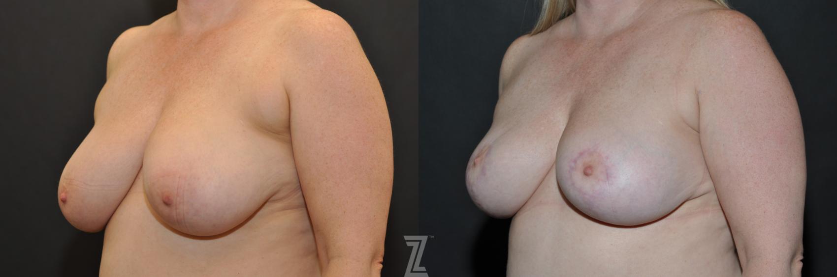 Breast Lift Before & After Photo | Austin, TX | The Piazza Center for Plastic Surgery & Advanced Skin Care