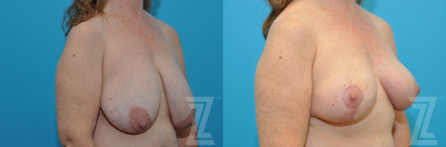 Breast Reduction Before & After Photo | Austin, TX | The Piazza Center for Plastic Surgery & Advanced Skin Care