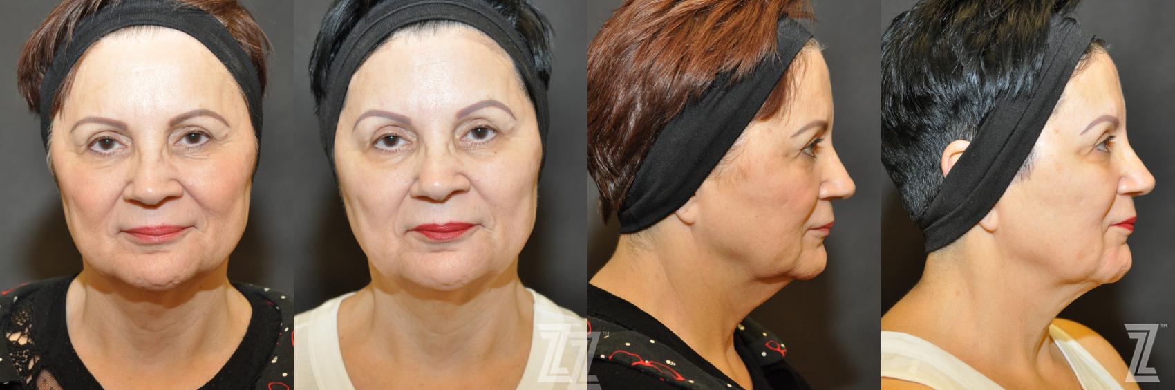 Chemical Peel Before & After Photo | Austin, TX | The Piazza Center for Plastic Surgery & Advanced Skin Care
