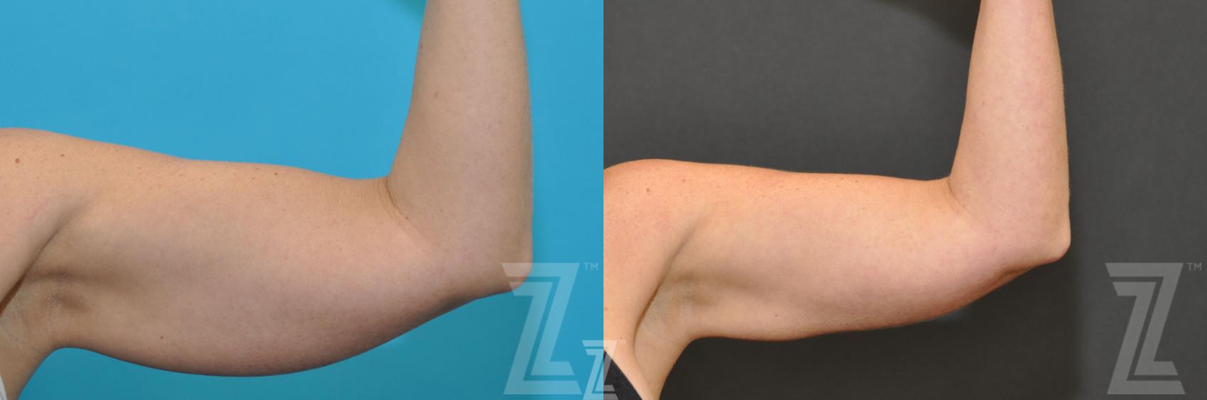 CoolSculpting® Before & After Photo | Austin, TX | The Piazza Center for Plastic Surgery & Advanced Skin Care