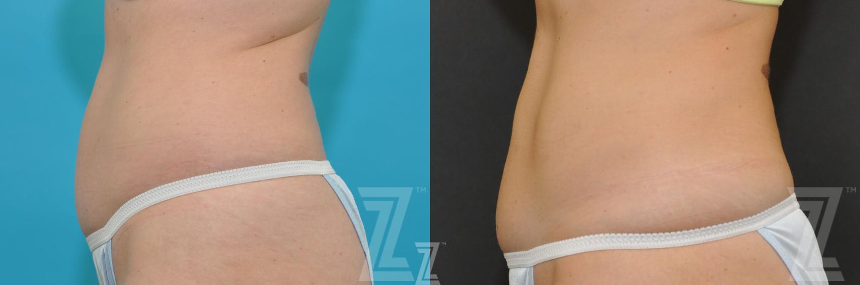 CoolSculpting® Before & After Photo | Austin, TX | The Piazza Center for Plastic Surgery & Advanced Skin Care