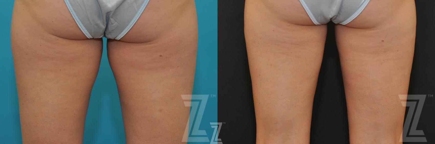 CoolSculpting® Before & After Photo | Austin, TX | The Piazza Center for Plastic Surgery & Advanced Skin Care