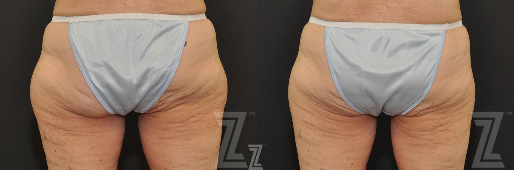 CoolSculpting® Before & After Photo | Austin, TX | The Piazza Center for Plastic Surgery & Advanced Skin Care