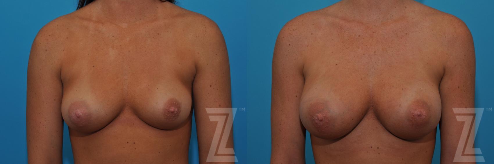 Correction of Breast Asymmetry Before & After Photo | Austin, TX | The Piazza Center for Plastic Surgery & Advanced Skin Care