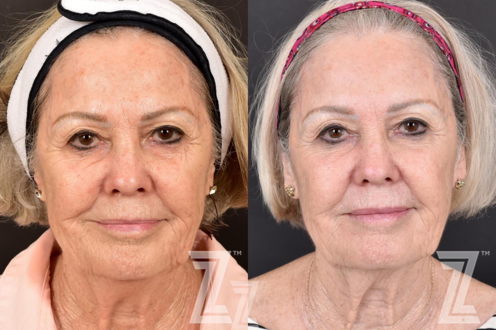 HALO Before & After Photo | Austin, TX | The Piazza Center for Plastic Surgery & Advanced Skin Care