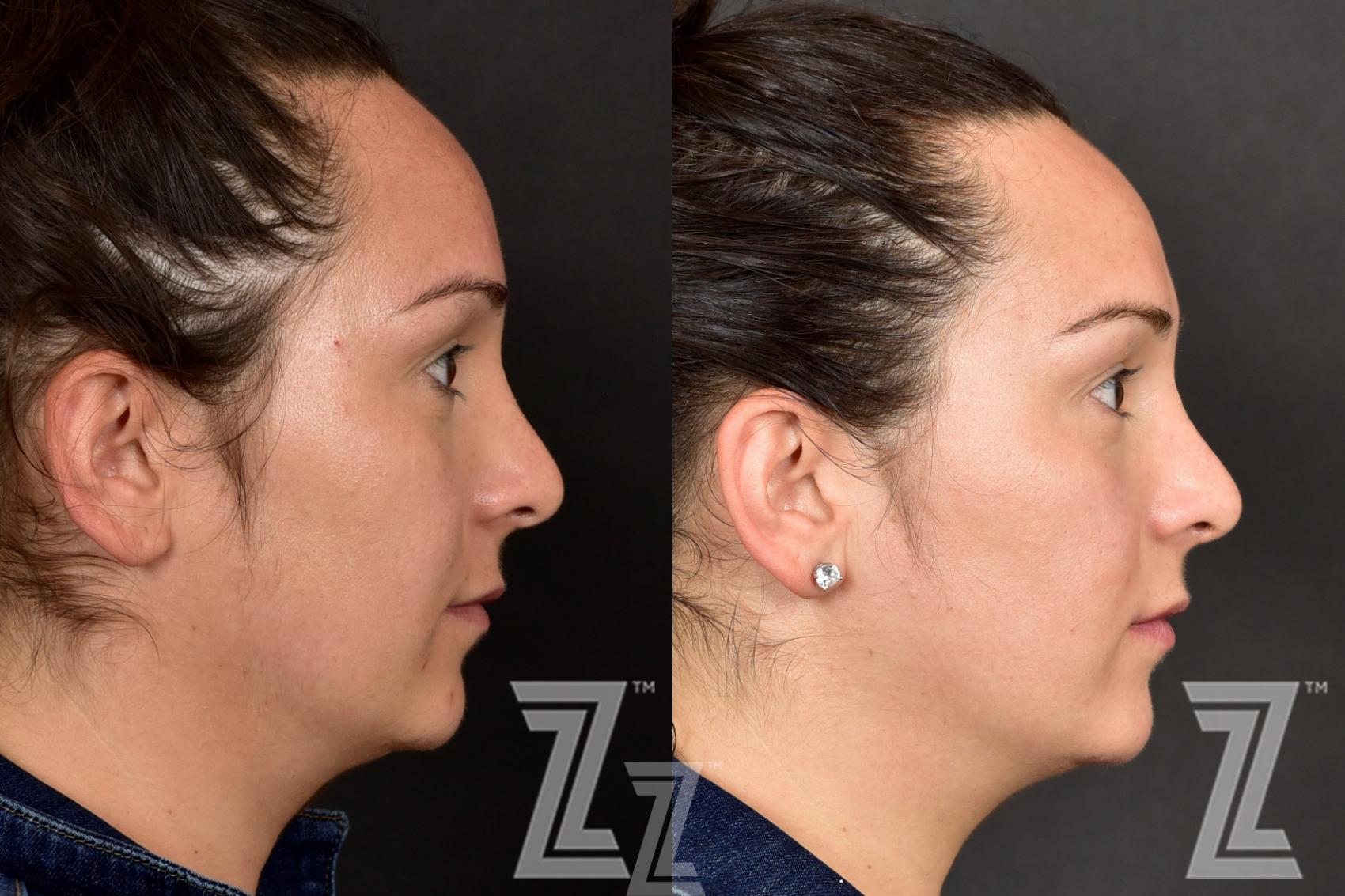 HALO Before & After Photo | Austin, TX | The Piazza Center for Plastic Surgery & Advanced Skin Care