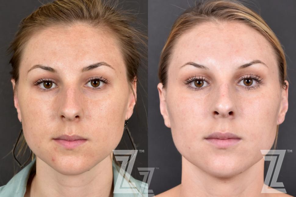 halo skin treatment