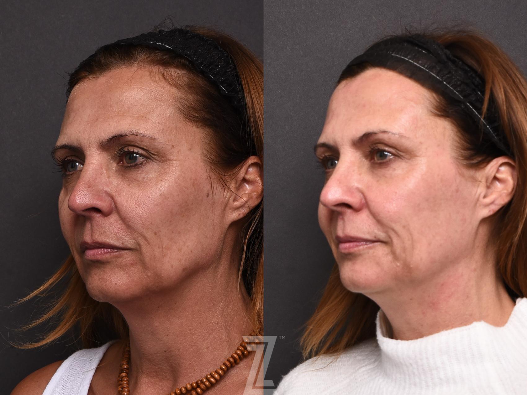 HALO Before & After Photo | Austin, TX | The Piazza Center for Plastic Surgery & Advanced Skin Care