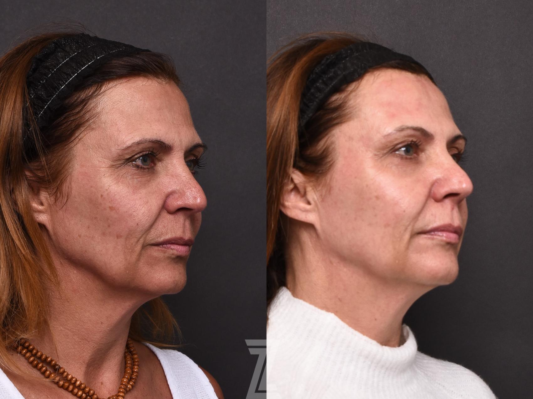 Botox, Neurotoxin, Dysport, Before and After, B&A, Tummy Tuck, Breast Aug, Breast Lift, Mastopexy, MMO, Mommy Makeover, Dr. Rocco Piazza, The Piazza Center, Austin, Tx, Halo, BBLlaser