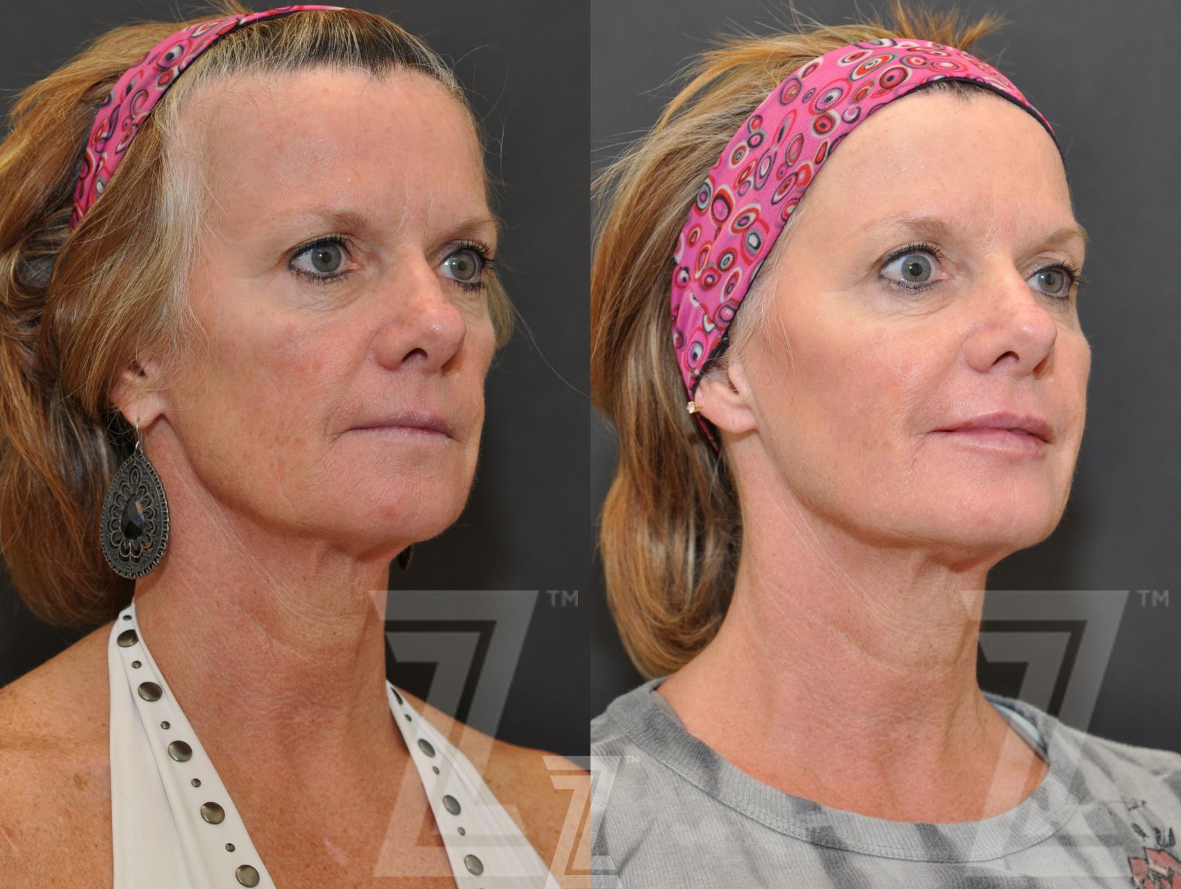 Injectable Fillers Before And After Photos Patient 262 Austin Tx The Piazza Center For 